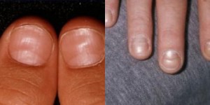 Fingernail Changes In Ibs Gluten Sensitivity And Celiac Disease Amy Burkhart Md Rd