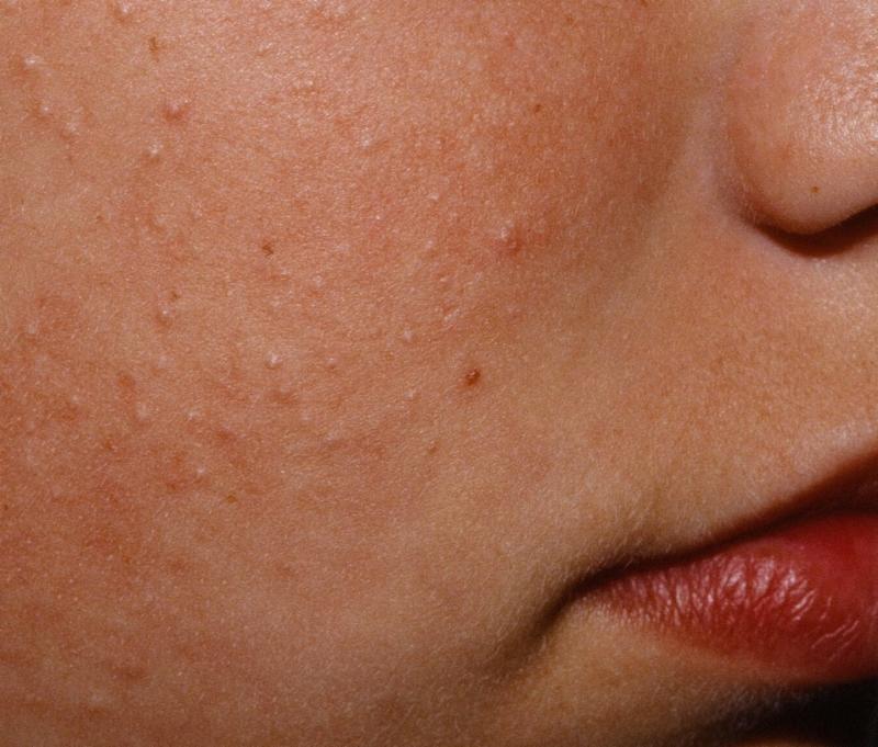 gluten rash chicken skin rash- keratosis pilaris rash can occur on cheeks like in this picture