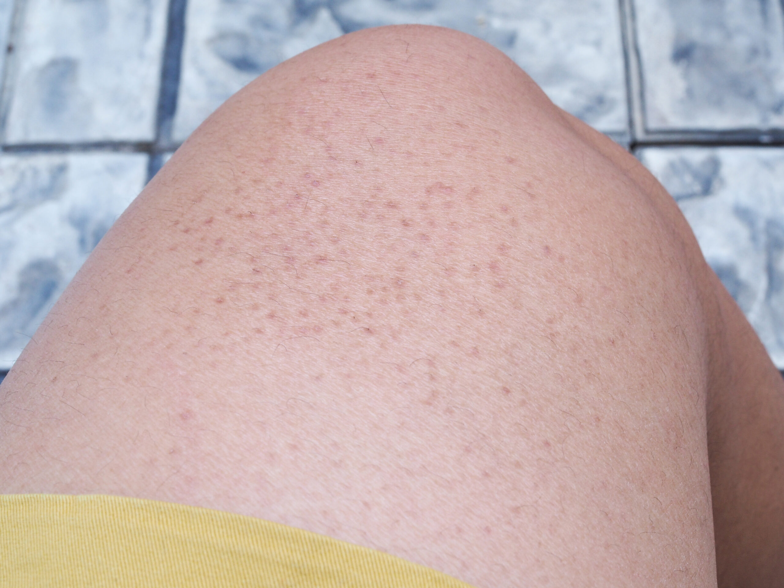 gluten rash image is of keratosis pilaris rash on legs. This rash can be worsened at times by gluten