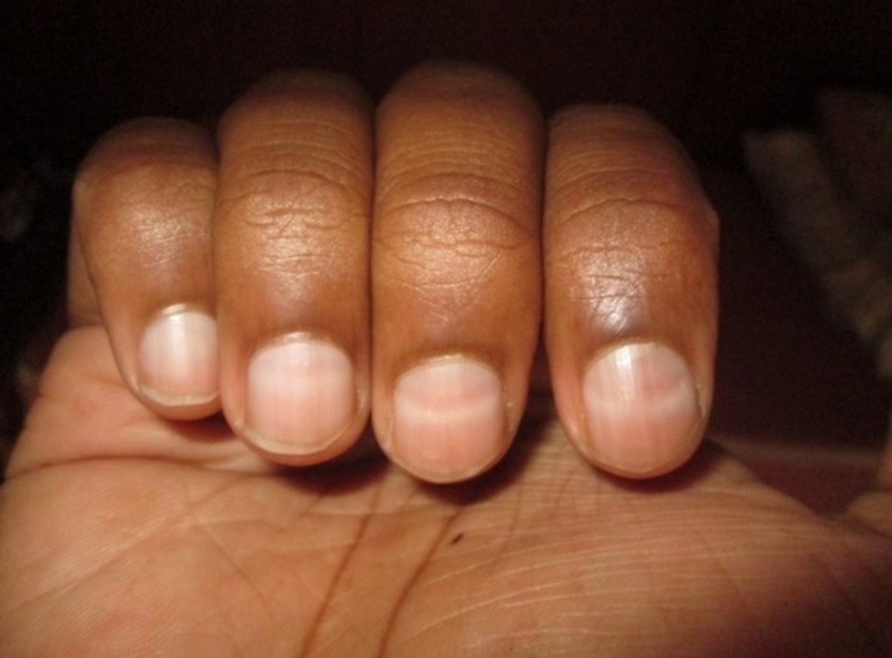 Blue Fingernails: Causes and When to Get Help