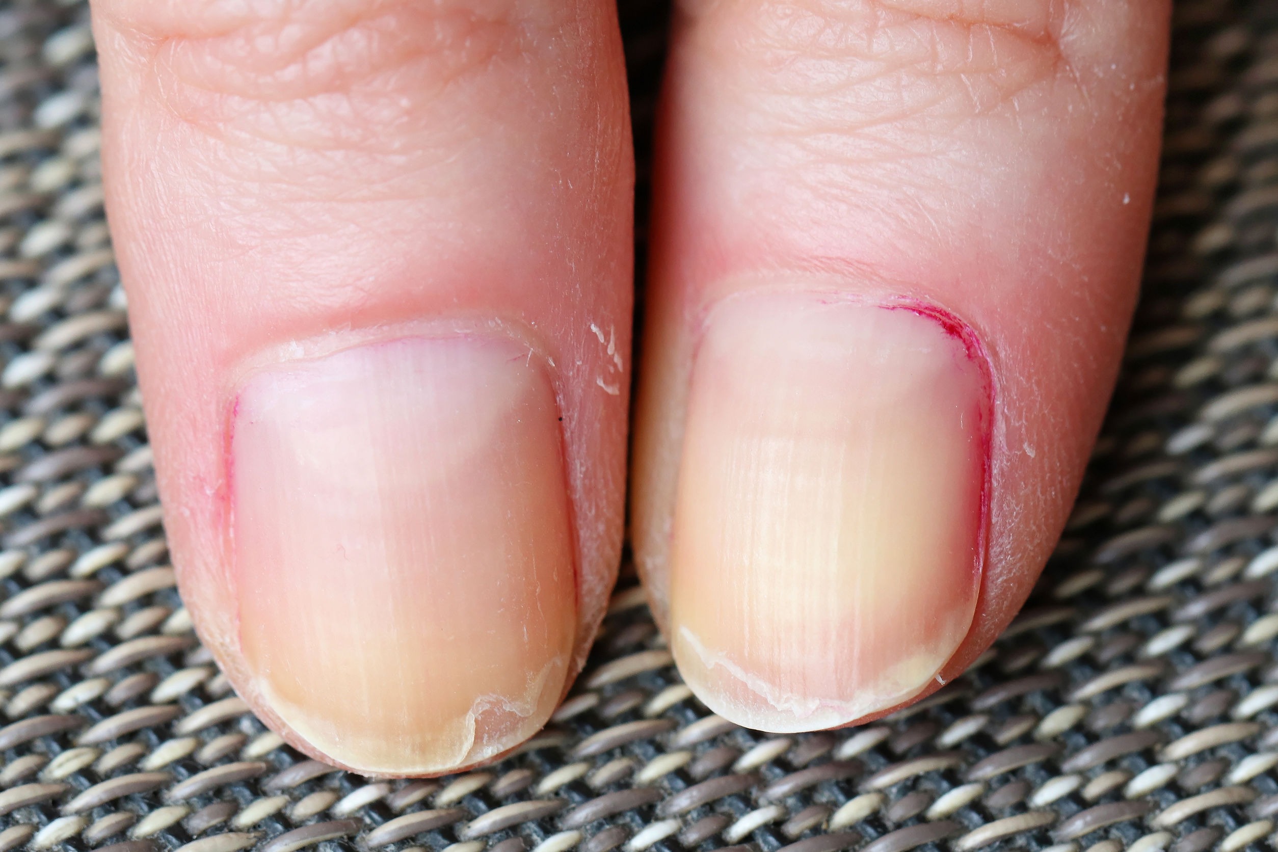 what-deficiency-causes-nails-to-split-vertically-mastery-wiki