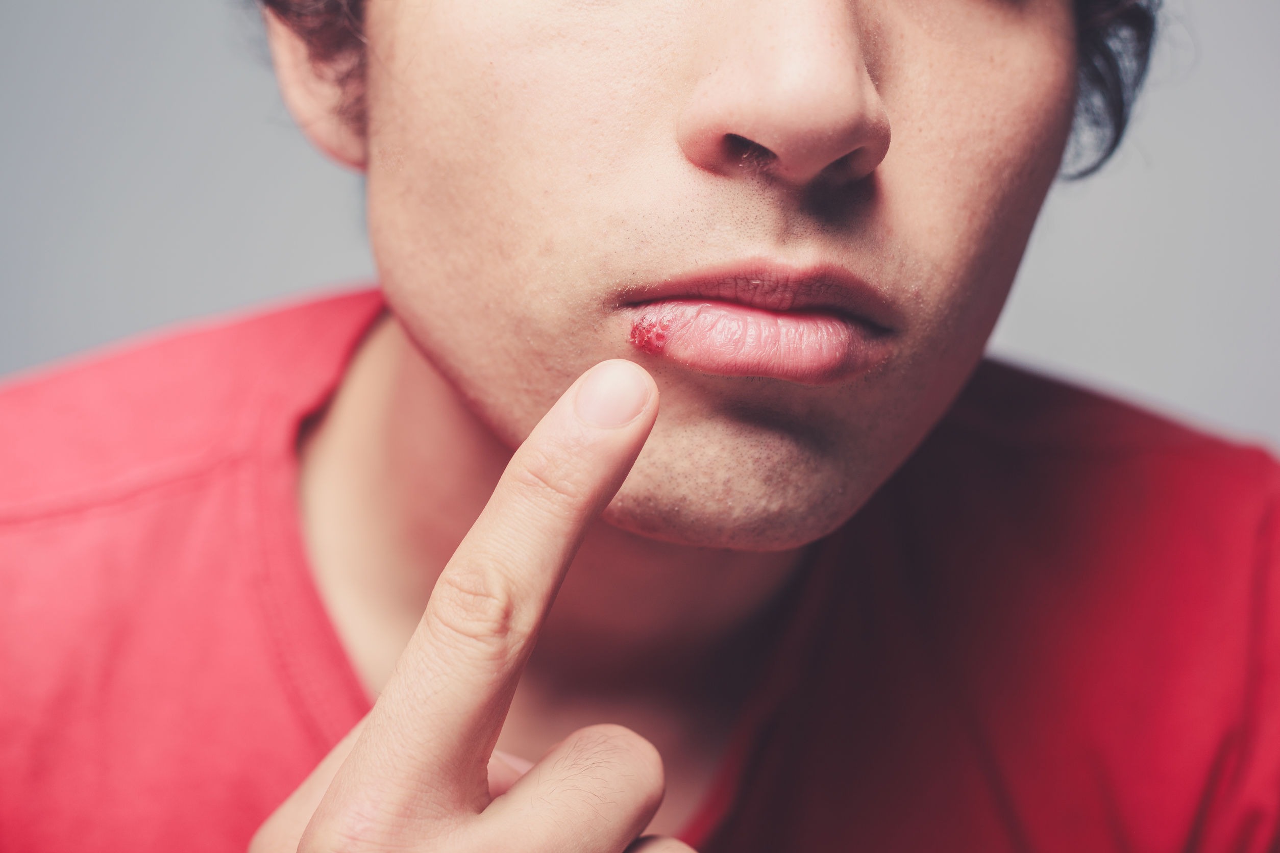 Cold sore on the lip of a young man. These can be triggered by gluten