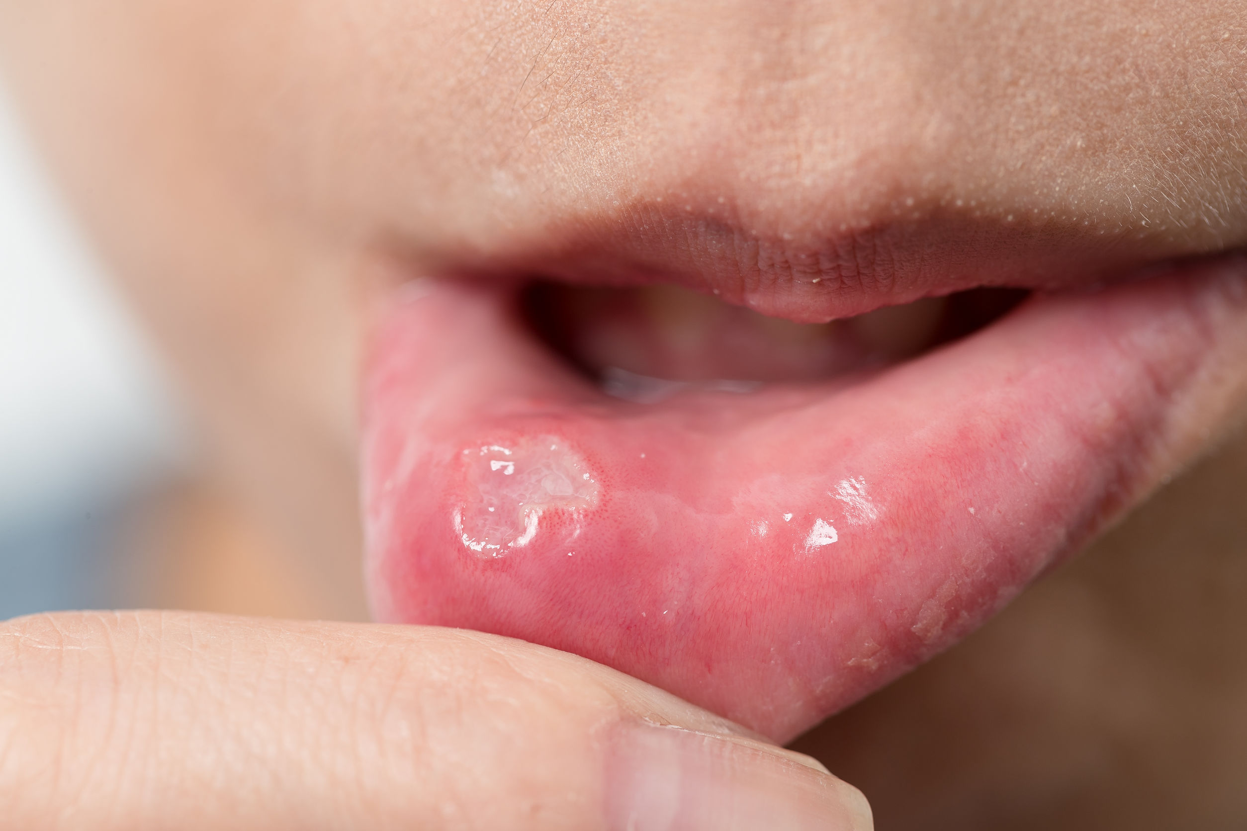 Canker sore on inside of mouth-canker sore may be triggered by gluten