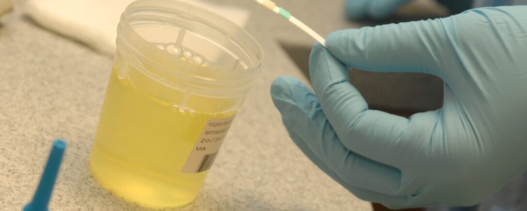 Una nueva prueba de orina para monitorear la exposición al gluten