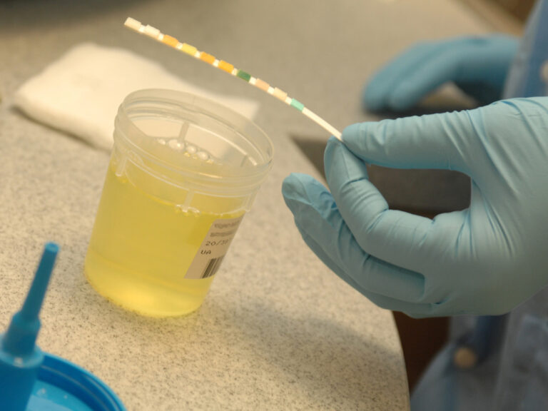 Una nueva prueba de orina para monitorear la exposición al gluten